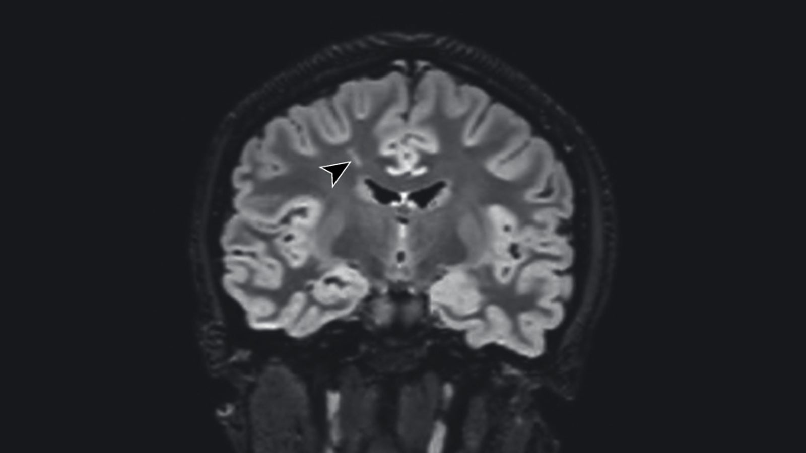 Photo: Bartley CM, et al/JAMA Neurology