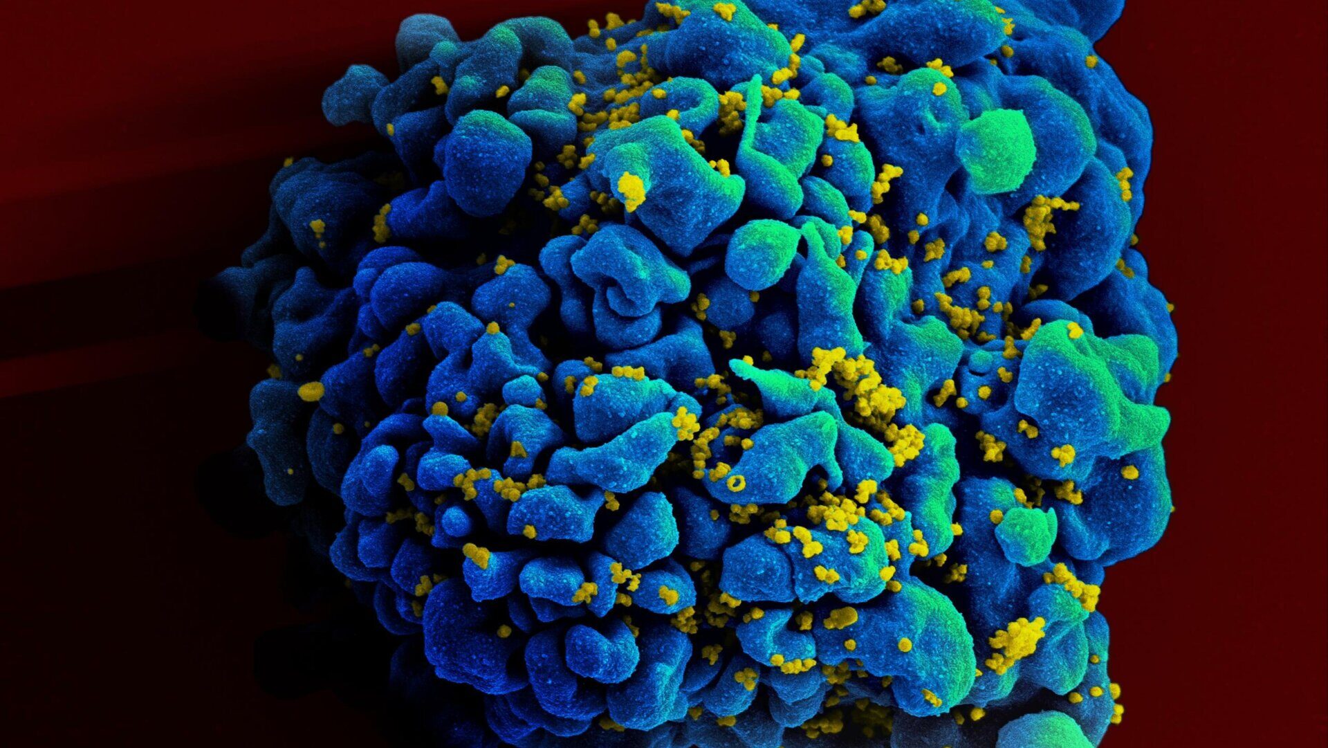 A T cell infected with HIV