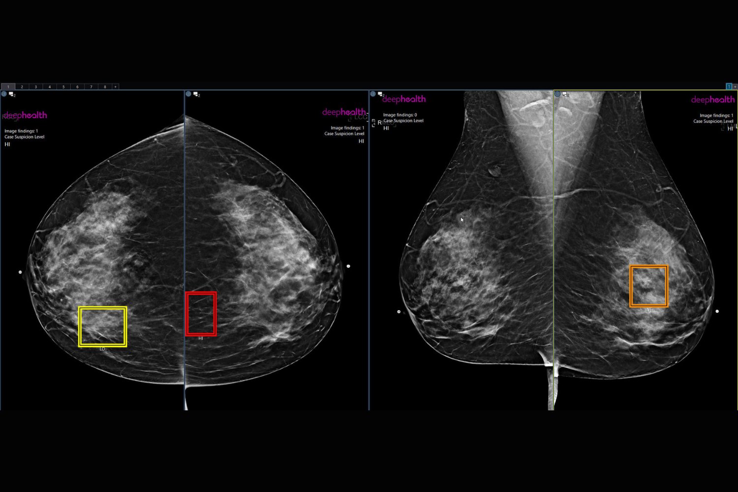 Ai Enhanced Mammogram