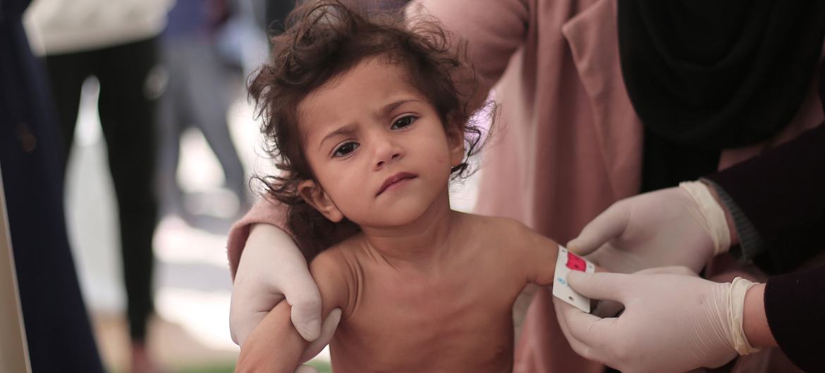 Many children in Gaza are showing signs of  severe acute malnutrition and drastic weight loss.