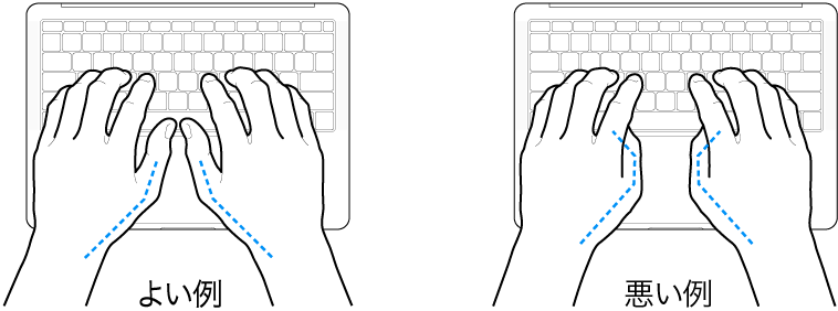 キーボードに置かれた手。親指の適切な位置と不適切な位置を示しています。