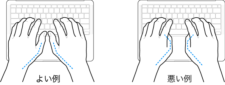 キーボードに置かれた手。親指の適切な位置と不適切な位置を示しています。