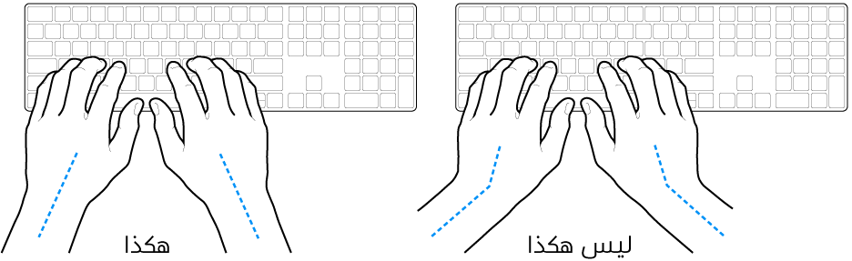 يدان موضوعتان على لوحة مفاتيح، وتظهر المحاذاة الصحيحة وغير الصحيحة للمعصم واليد.