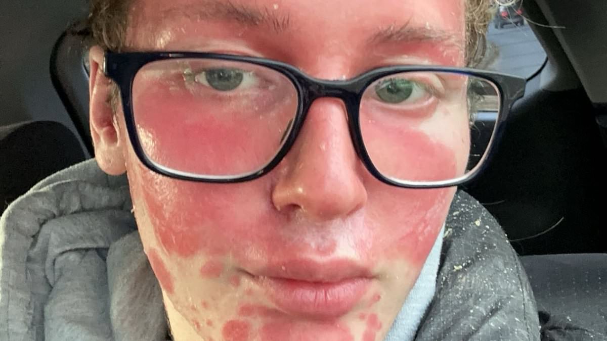 I had lip filler injections to look like an influencer... but then they gave me the WORST case of psoriasis my doctor had ever seen