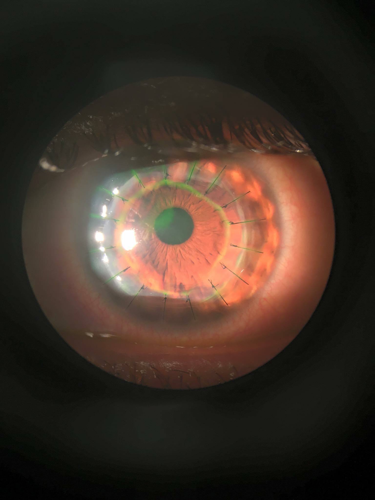 Transplants can restore sight for people with deformed, infected, or damaged corneas. Typically, the original cornea is removed and a healthy one from a deceased donor is stitched into place, with stitches remaining in place for between a month and several years. (Michael Nadel via KFF Health News)