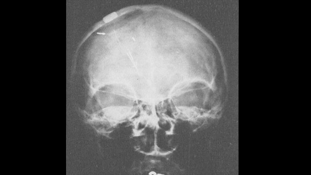 x-ray of a skull