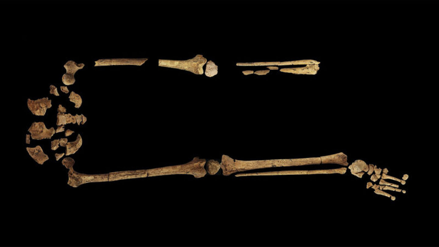 Human skeleton from waist down showing earliest surgery