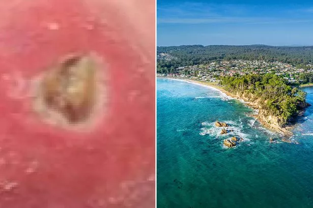 Case of Buruli Ulcer and Australia