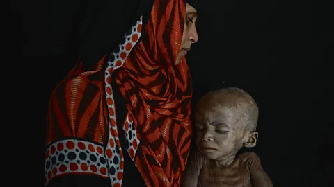 Getty Images While images of malnourished Ethiopian children featured heavily in the news during the 1980s, victims of famine in Yemen have largely been ignored (Credit: Getty Images)