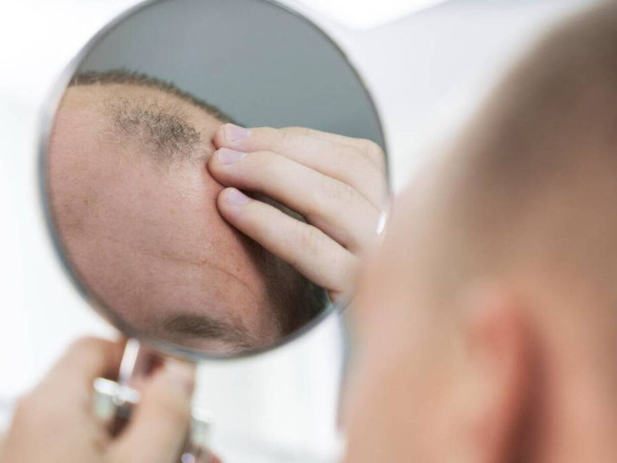 Foto: Un simple gel podría tener la llave para recuperar el cabello (Freepik)