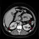 Kidney Angiomyolipoma