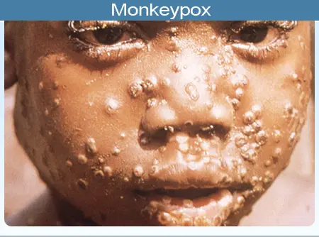 Picture of the pustules/papules of characteristic mpox rash