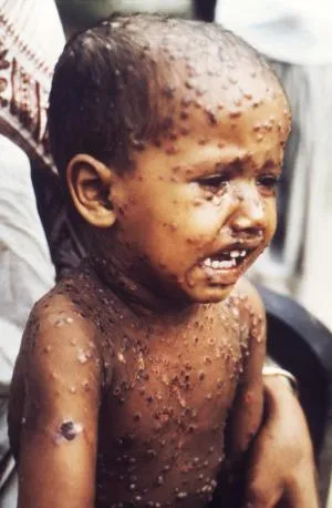 Picture of smallpox in a young child.