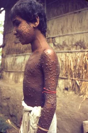 Picture of smallpox in a child.