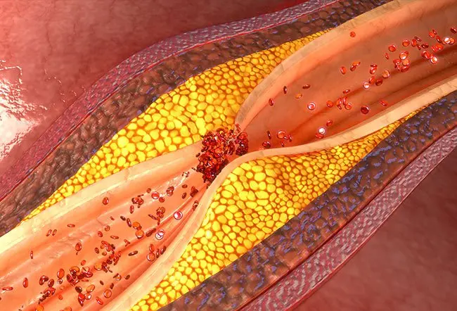 Atherosclerosis causes plaque to clog and narrow your arteries over time.