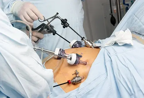 Photo showing the bariatric surgery procedure.