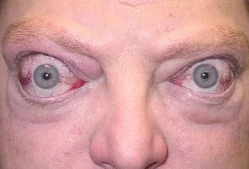 Often a sign of a medical problem, bulging eyes can be caused by various health issues.