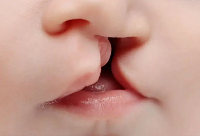 Cleft Palate and Cleft Lip