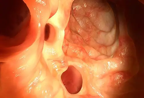 Diverticulitis can go away, but it should be evaluated by your doctor. 