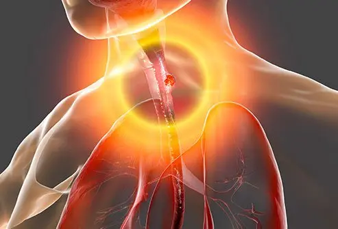 Gastroesophageal junction adenocarcinomas are staged and treated the same as cancers of the esophagus and are typically considered to be a form of esophageal cancer.