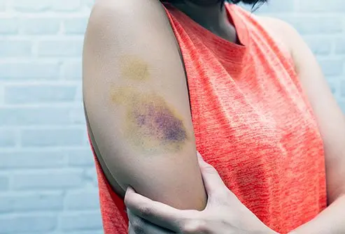 A hematoma is not a bruise. Depending on the cause, it can take anywhere from 1 to 4 weeks for a hematoma to go away.