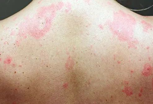 Hives are red, itchy skin rashes 