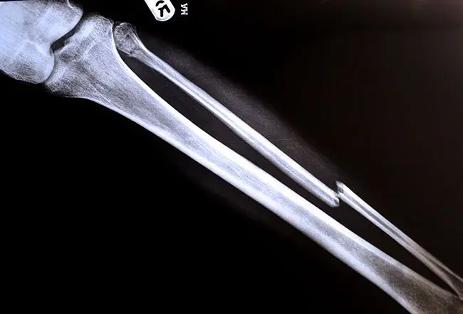 The fibula is the long, thin bone of the lower leg on the side of the little toe. The fibula usually takes about three to six months to heal. 