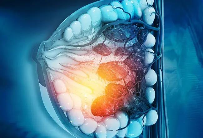 The cancer is called IBC because its symptoms appear as though the breast is inflamed or infected. Unlike other types of breast cancer that cause a lump in the breast, IBC does not cause any mass or lump.