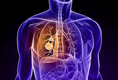 Metastatic lung cancer survival rate