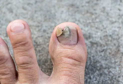 An injury to the nail bed may require a trip to the ER depending on the extent of the injury.