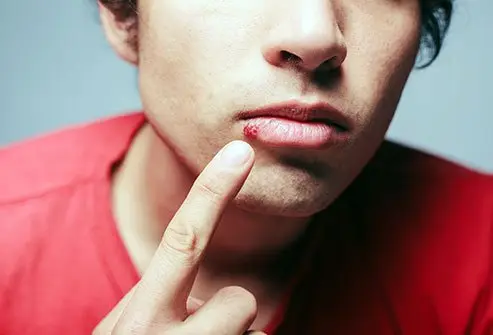 Cold sores are small blisters that appear on the lips and face. They are caused by the herpes simplex virus-1 (HSV-1). Genital herpes is caused by the HSV-2 virus and it is spread by sexual contact. Both HSV-1 and HSV-2 can cause sores on the mouth and genitals. 