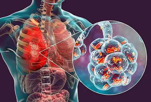 Pneumonia is an infection that affects one or both lungs causing them to fill with pus or liquid. The three main causes of pneumonia are bacteria, viruses, or fungi. Treatment is depends on the cause.