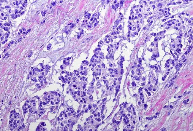 Rhabdomyosarcoma (RMS)