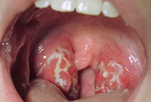 Rheumatic fever is an autoimmune disease that sometimes occurs after strep throat.