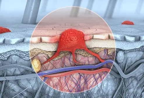  Melanoma Skin Cancer  