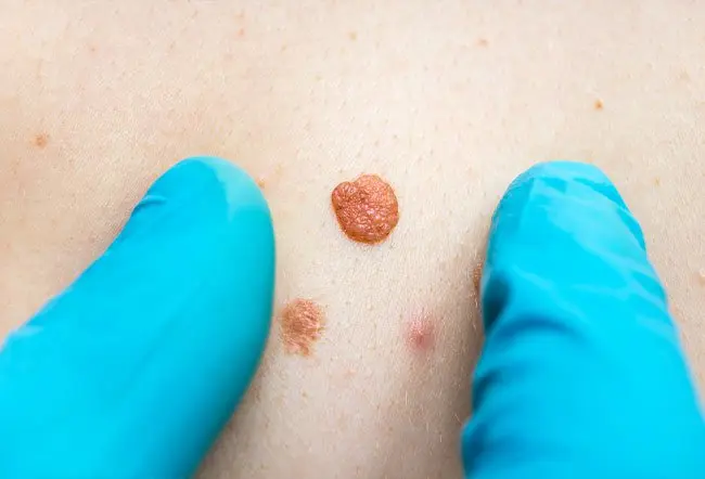 Skin Tag