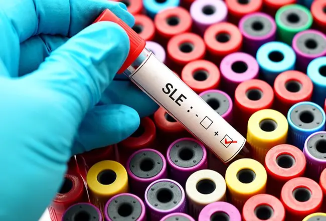 Lupus is an autoimmune condition and lupus anticoagulant refers to antiphospholipid antibody syndrome. Lupus and lupus anticoagulant are not the same. 