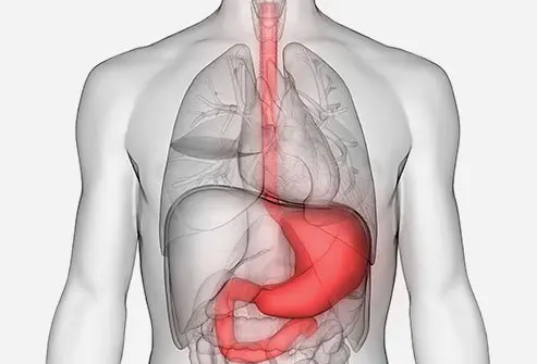 Leiomyosarcoma