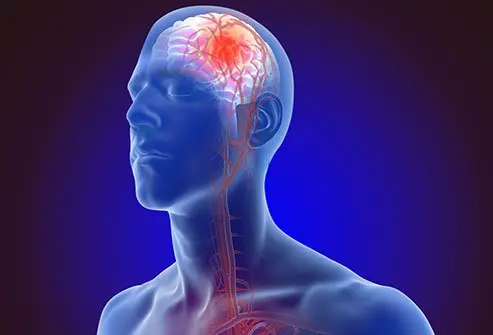 Stroke causes, treatment, prevention, symptoms, signs of a stroke, and types stroke