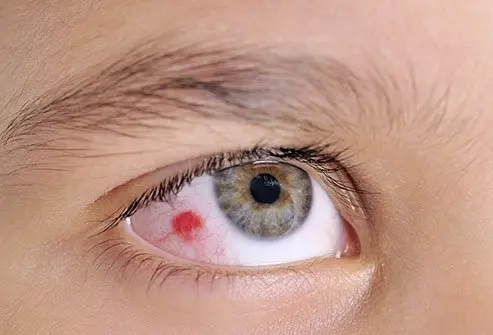 A red patch on the white of the eye is a sign of a subconjunctival hemorrhage.