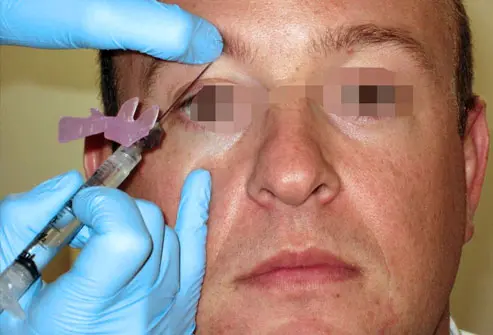 A supraorbital nerve block is a procedure to provide regional anesthesia to the area of the face from the upper eyelid to the top of the head.