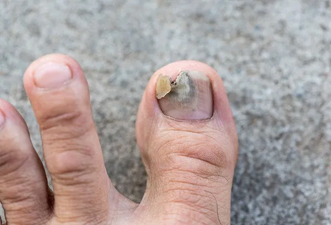 Toe nail infection