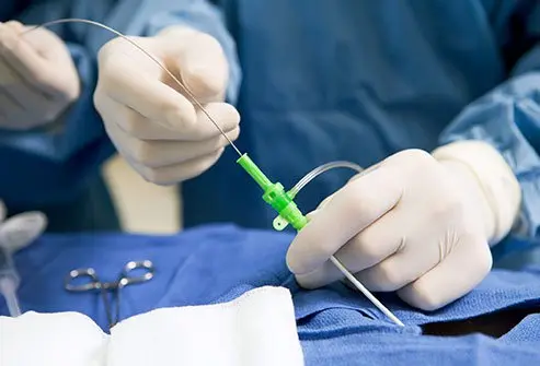 During a heart catheterization, doctors insert the tube into a blood vessel. There are two types of cardiac catheterization, left and right heart catheterization. 