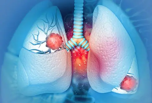 Lung cancer takes several years to develop and show symptoms.