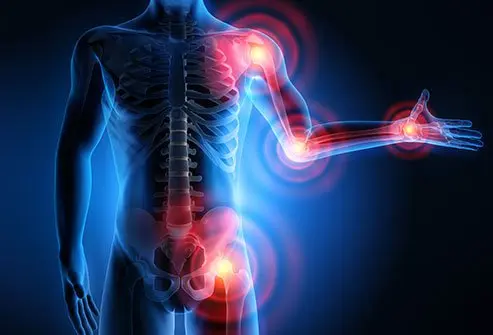 Rheumatoid Arthritis vs. Crohn's Disease