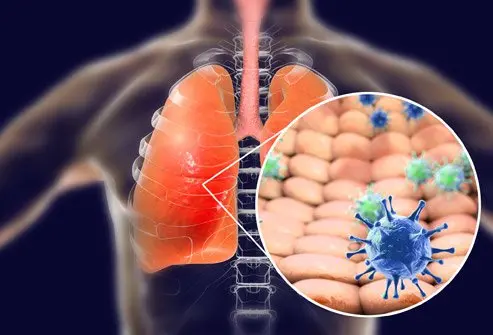 Infection with the Wuhan coronavirus causes respiratory problems.