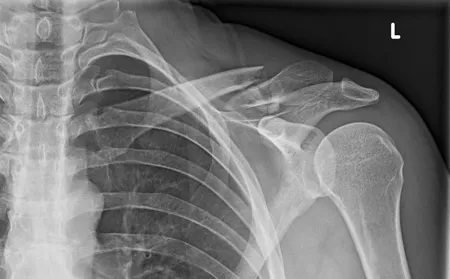 X-ray of a broken collarbone (clavicle)