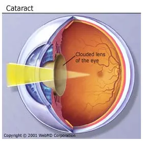 Picture of Cataract of the Eye