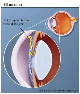 Picture of Glaucoma of the Eye