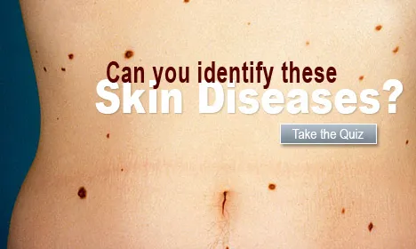 Skin Disease Quiz